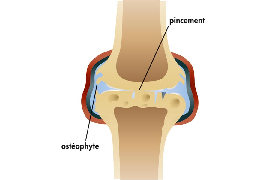 L'arthrose: comment la reconnaître et la soulager !